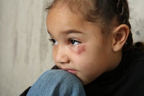 Father Reports Mother for Physically Abusing Child with Dustpan 1 Girl with bruise on her eye