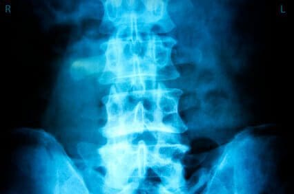 What Should I Bring to the Initial Consultation for My Spinal Injury Case? 1 What Should I Bring to the Initial Consultation for My Spinal Injury Case? iStock 000010083633XSmall