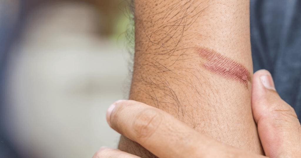 burn risks