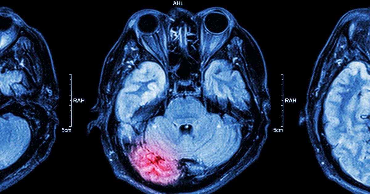 anoxic hypoxic brain injury